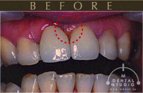 施術前写真(前歯)