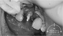 施術中写真(前歯)