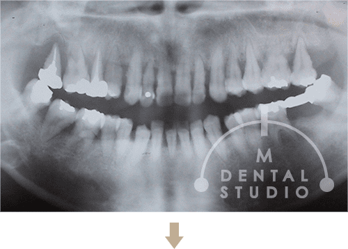 重症歯周病患者(レントゲン写真)