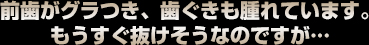 前歯がグラつき、歯ぐきも腫れています。 もうすぐ抜けそうなのですが...