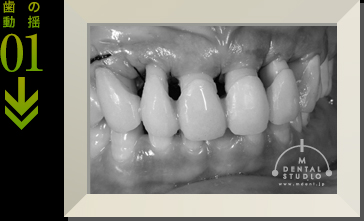 歯の動揺01(上写真)