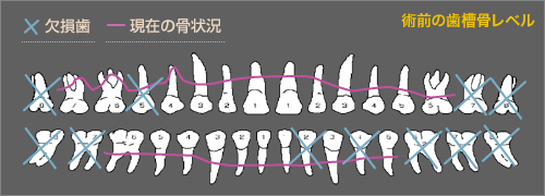 術前の歯槽骨レベル(欠損歯/現在の骨状況)図