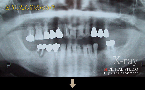 レントゲン写真(どうしたら治るのか？)