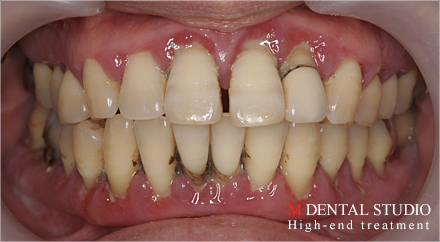 重度歯周病 歯がぐらぐら治るために 触ると抜ける 型取りすら出来ない Part2 治療実績集 歯周病治療 大阪の歯科クリニック Mdental Studio