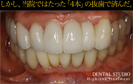 術後写真(しかし、当院ではたった「4本」の抜歯で済んだ)