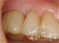 施術後写真(歯ぐき)2