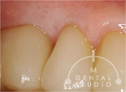 施術後写真(歯ぐき)3