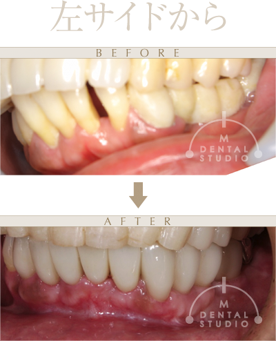 施術前後写真(左サイド)