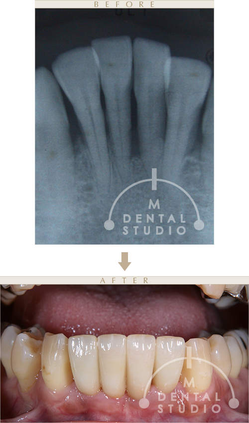 術前・術後写真(下顎)