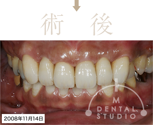 2008年11月14日 術後写真