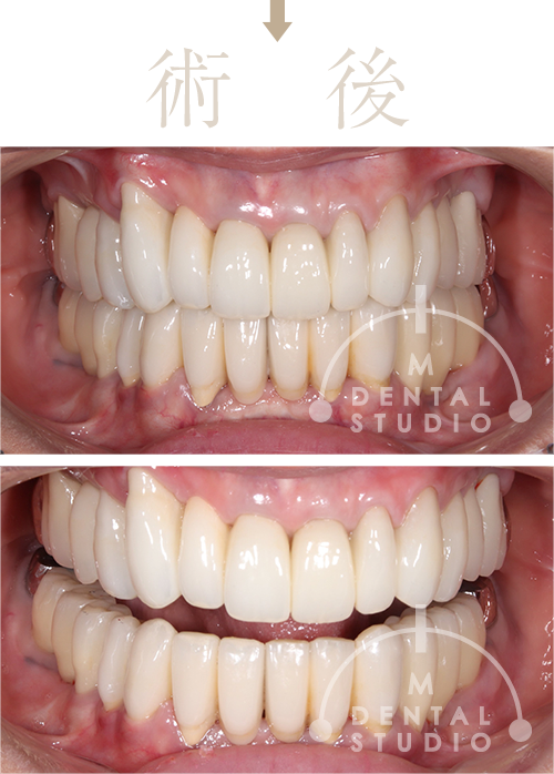 術後写真