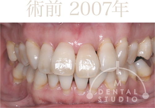 2007年 術前写真