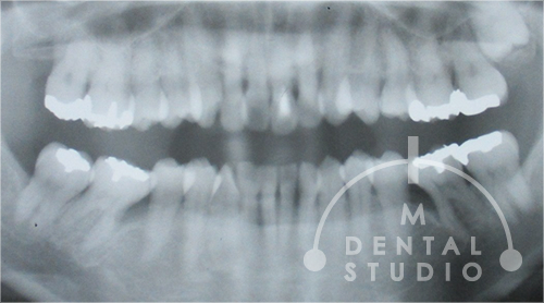 2007年 術前レントゲン写真