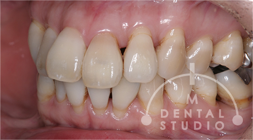 術前写真(右側)