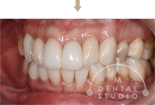 術後写真(右側)