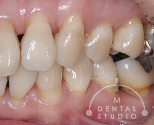 術前写真(右側)