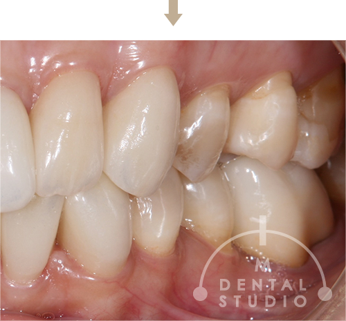 術後写真(右側)