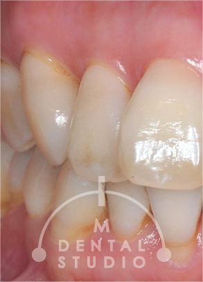 術前写真(左側)