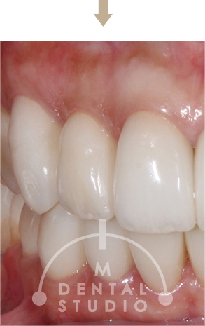 術後写真(左側)