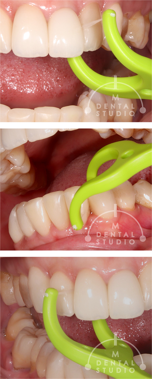 糸ようじ(フロス)写真