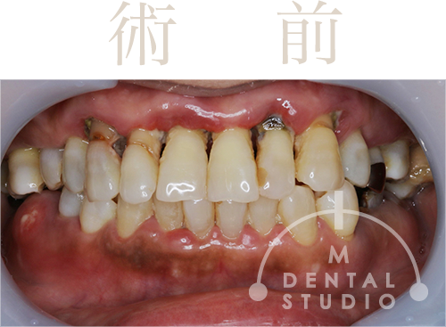 正面写真(術前)