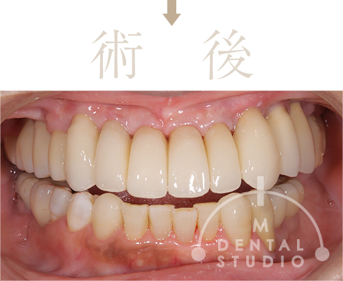 正面写真(術後)