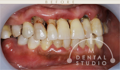 左側写真(術前)