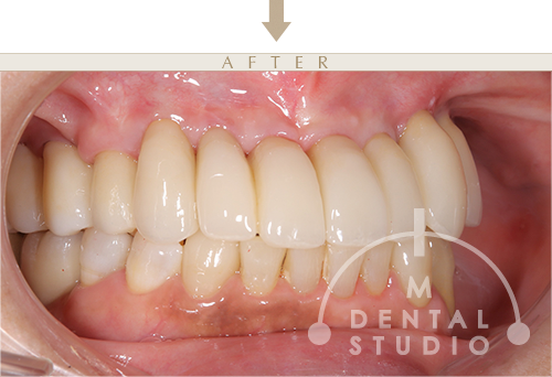 左側写真(術後)