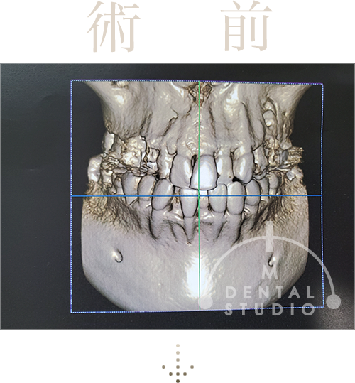 術前写真(CT)