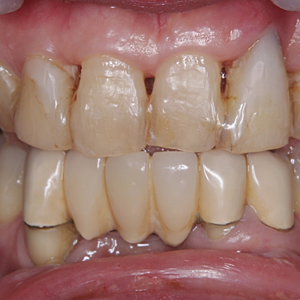 軽度】前歯の歯周病を審美的に治せますか？ - 治療実績集 | 審美治療