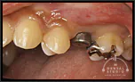 審美インプラントVol.19永久歯の先天性欠損によるインプラント技術