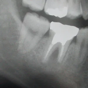 レントゲンから見るインプラントの説明・事例