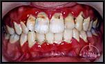 【軽度】歯医者が怖くて通院せず、歯周病治療による審美的回復