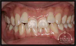【出っ歯・乱ぐい】ほぼ成長が止まっている非抜歯の歯列矯正