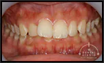 【出っ歯】下の前歯が見えないぐらい出っ歯になってる顎関節症も治る