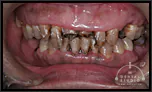 【中度】アゴの骨折、それによるアゴのズレ さらに歯周病・ひどい虫歯による歯の崩壊