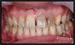 オールセラミッククラウンによるすきっ歯の治療