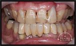 【軽度】前歯の歯周病を審美的に治せますか？