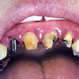 歯周病治療による審美的要求