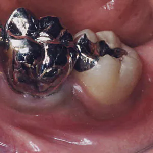 保険治療の虫歯治療例