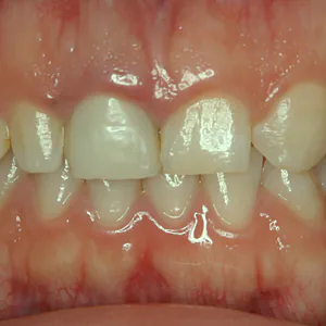 歯が小さいこと、左右非対称な歯の形がコンプレックスです。