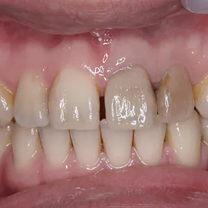 オールセラミッククラウンによるすきっ歯の治療