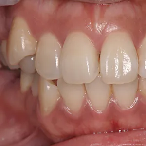 矯正技術しても、歯の１つ１つが大きく目立つかな？