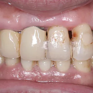 【重度】各所の歯に接着剤にて固定の跡が見えます。