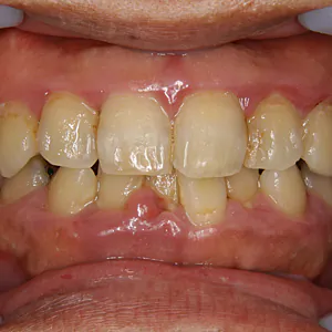 【中度】奥歯も含め中度の歯周病！特に下の前歯はもう大変！