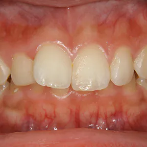 【出っ歯】下の前歯が見えないぐらい出っ歯になってる顎関節症も治る