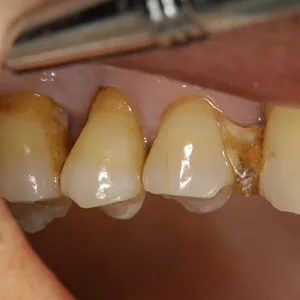 【中度】奥歯の歯ぐきの変化
