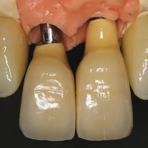 審美インプラントVol.20 前歯のブリッジの歯が完全に1本抜けている事例