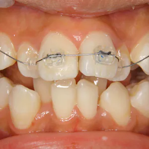 【出っ歯・乱ぐい】成長期すぎての非抜歯矯正技術