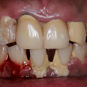 【重症の軽度】キレイな歯ぐきと美しい歯を取り戻すことが出来るのか？